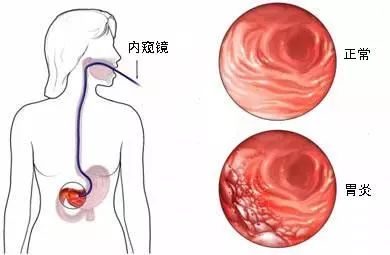 一枚小膠囊，看清你的胃！