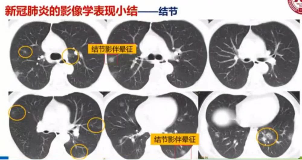 AI助力疫情防控，專利為其保駕護航！