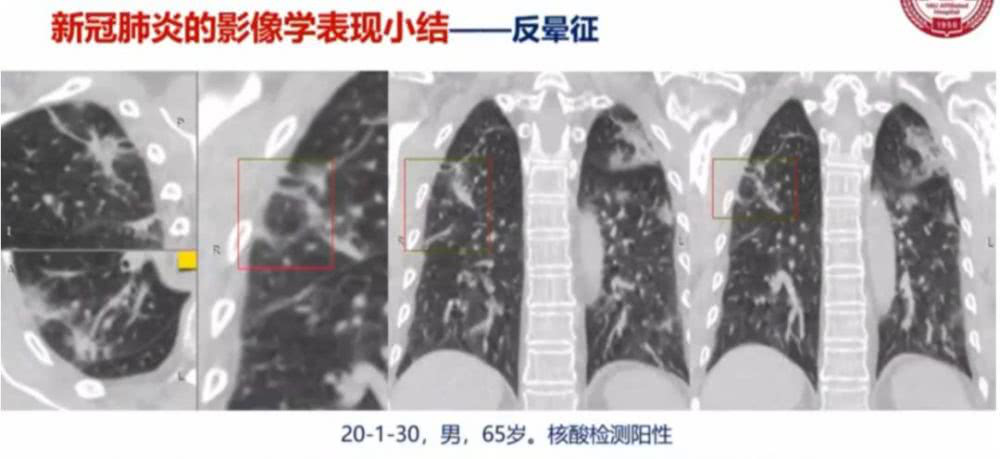 AI助力疫情防控，專利為其保駕護航！